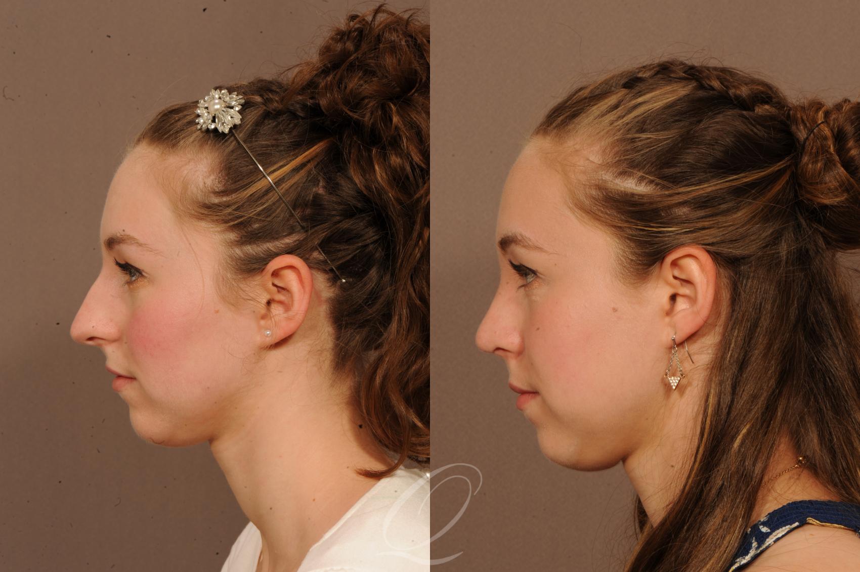 Rhinoplasty Case 1515 Before & After View #3 | Serving Rochester, Syracuse & Buffalo, NY | Quatela Center for Plastic Surgery