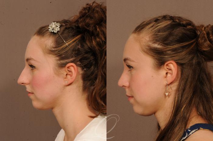 Rhinoplasty Case 1515 Before & After View #3 | Serving Rochester, Syracuse & Buffalo, NY | Quatela Center for Plastic Surgery