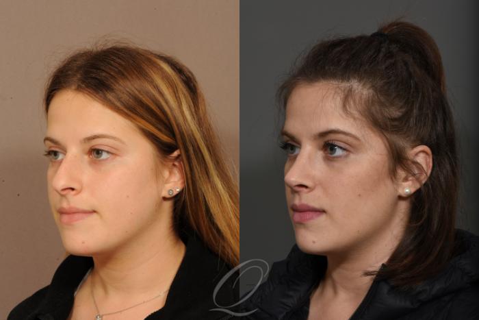 Rhinoplasty Case 1531 Before & After View #2 | Serving Rochester, Syracuse & Buffalo, NY | Quatela Center for Plastic Surgery