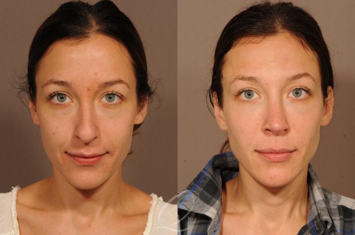 Rhinoplasty Case 295 Before & After View #1 | Serving Rochester, Syracuse & Buffalo, NY | Quatela Center for Plastic Surgery