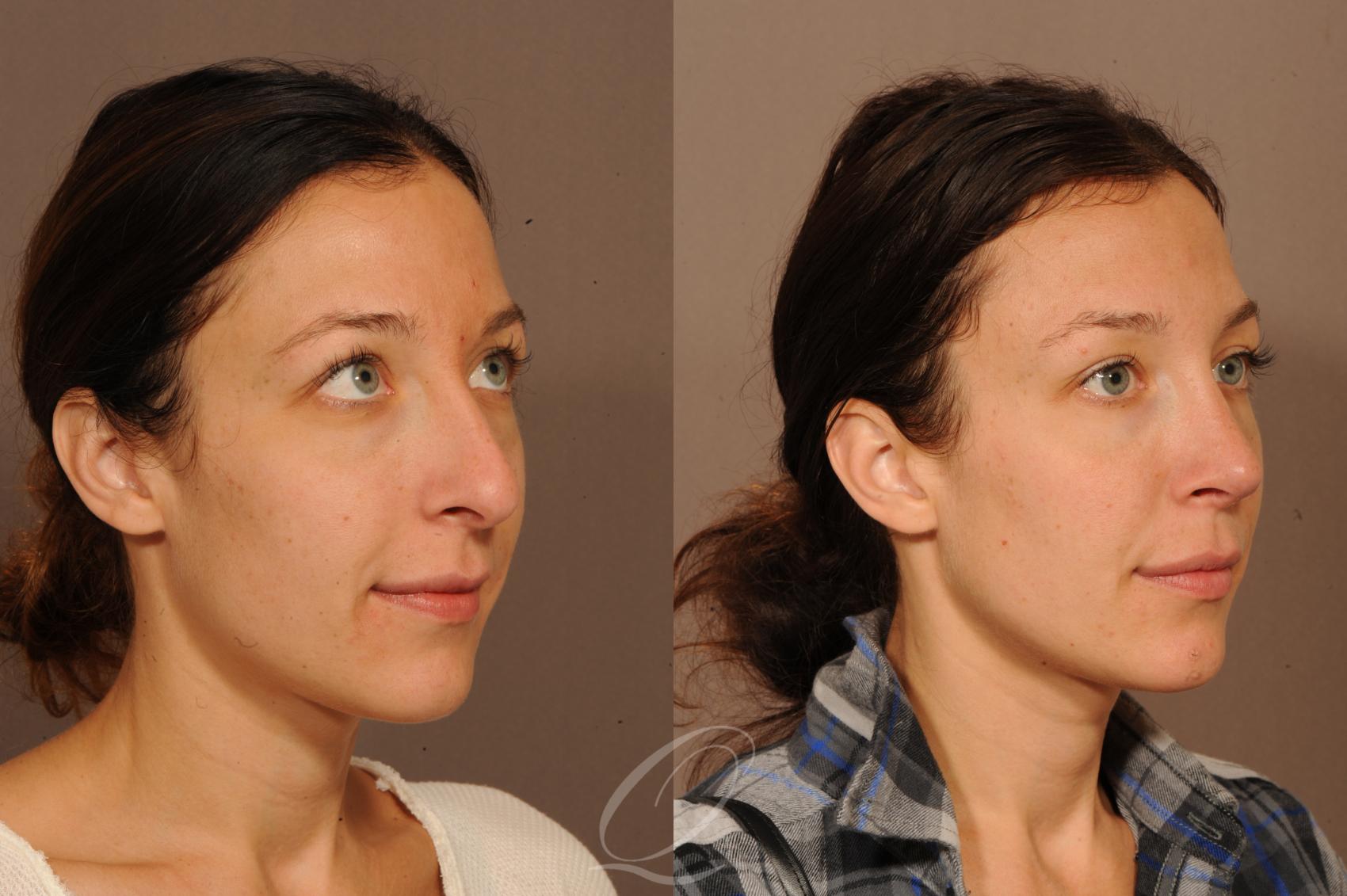 Rhinoplasty Case 295 Before & After View #2 | Serving Rochester, Syracuse & Buffalo, NY | Quatela Center for Plastic Surgery