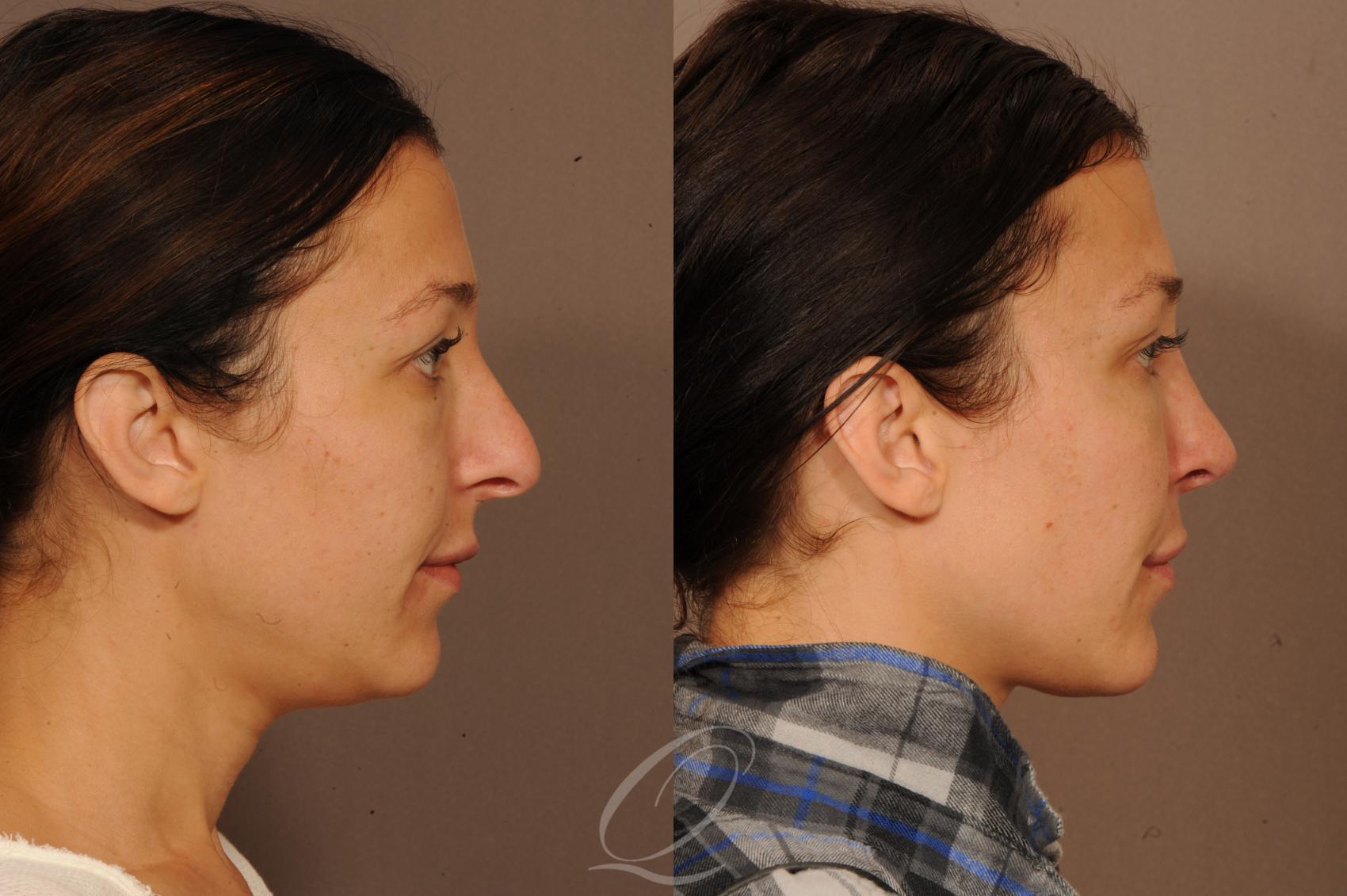 Rhinoplasty Case 295 Before & After View #3 | Serving Rochester, Syracuse & Buffalo, NY | Quatela Center for Plastic Surgery