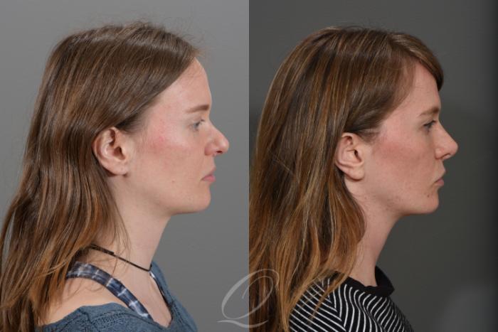 Rhinoplasty Case 342 Before & After View #3 | Serving Rochester, Syracuse & Buffalo, NY | Quatela Center for Plastic Surgery