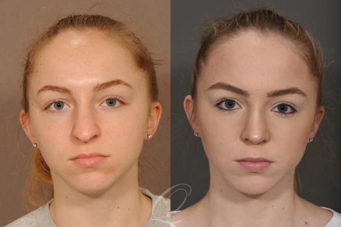 Rhinoplasty Case 359 Before & After View #1 | Serving Rochester, Syracuse & Buffalo, NY | Quatela Center for Plastic Surgery