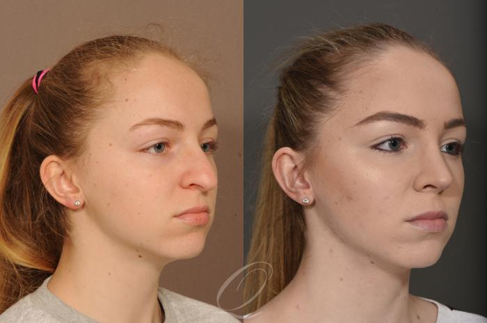 Rhinoplasty Case 359 Before & After View #2 | Serving Rochester, Syracuse & Buffalo, NY | Quatela Center for Plastic Surgery