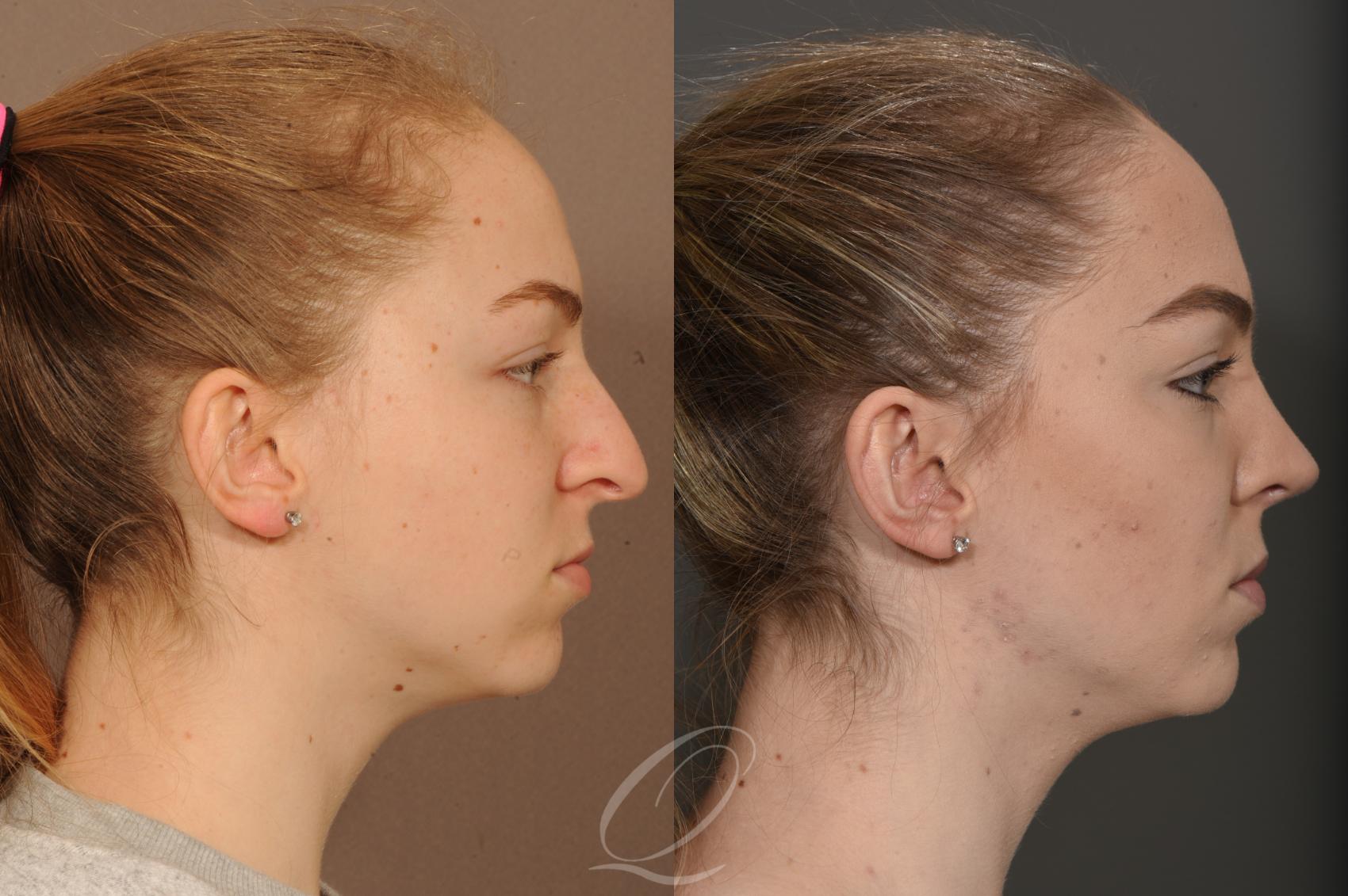 Rhinoplasty Case 359 Before & After View #3 | Serving Rochester, Syracuse & Buffalo, NY | Quatela Center for Plastic Surgery
