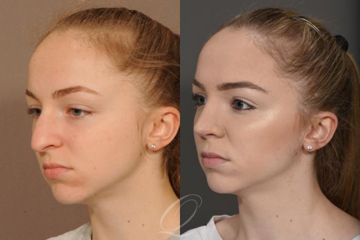 Rhinoplasty Case 359 Before & After View #4 | Serving Rochester, Syracuse & Buffalo, NY | Quatela Center for Plastic Surgery
