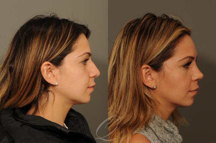 Rhinoplasty Case 360 Before & After View #2 | Serving Rochester, Syracuse & Buffalo, NY | Quatela Center for Plastic Surgery