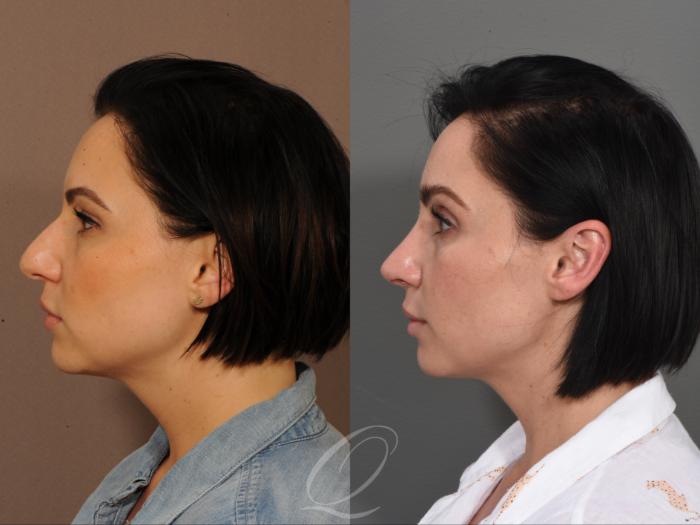 Rhinoplasty Case 361 Before & After Left Side | Serving Rochester, Syracuse & Buffalo, NY | Quatela Center for Plastic Surgery