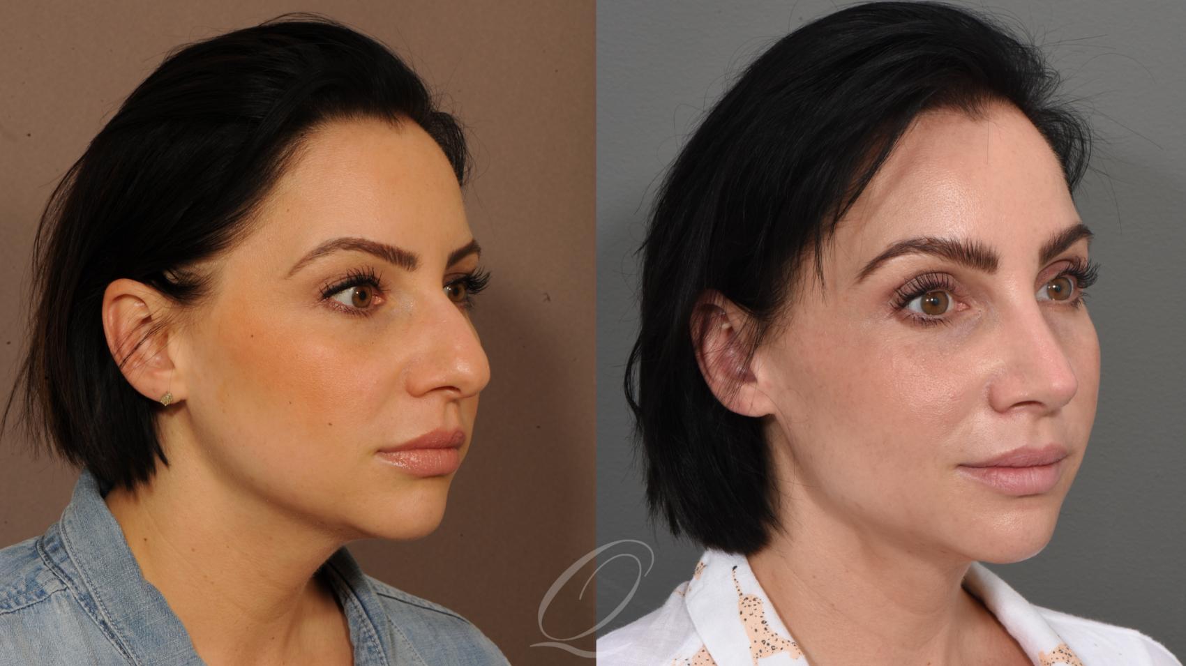 Rhinoplasty Case 361 Before & After View #1 | Serving Rochester, Syracuse & Buffalo, NY | Quatela Center for Plastic Surgery