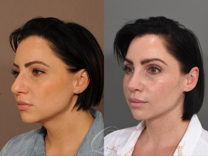 Rhinoplasty Case 361 Before & After View #2 | Serving Rochester, Syracuse & Buffalo, NY | Quatela Center for Plastic Surgery