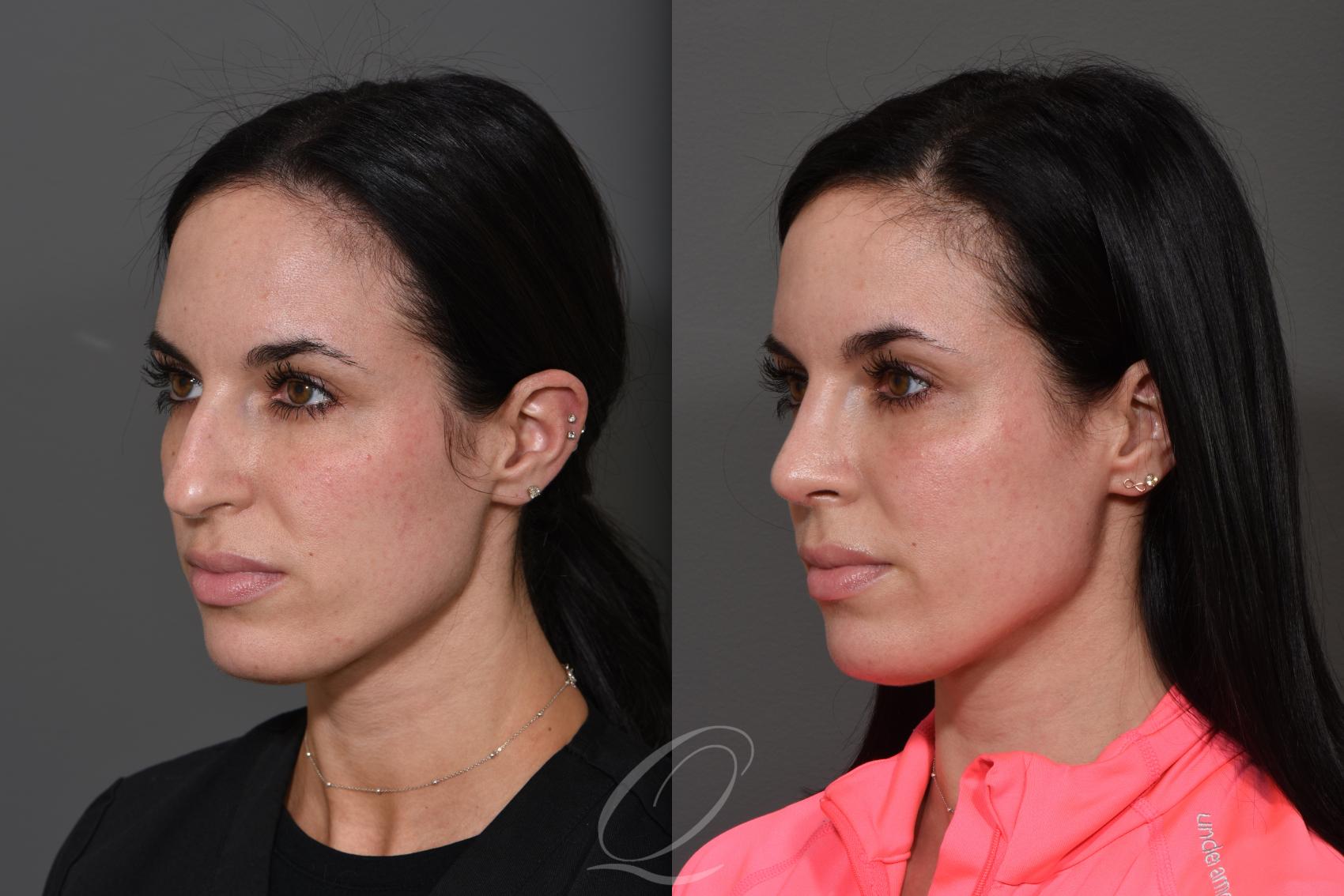 Rhinoplasty Case 362 Before & After View #2 | Serving Rochester, Syracuse & Buffalo, NY | Quatela Center for Plastic Surgery