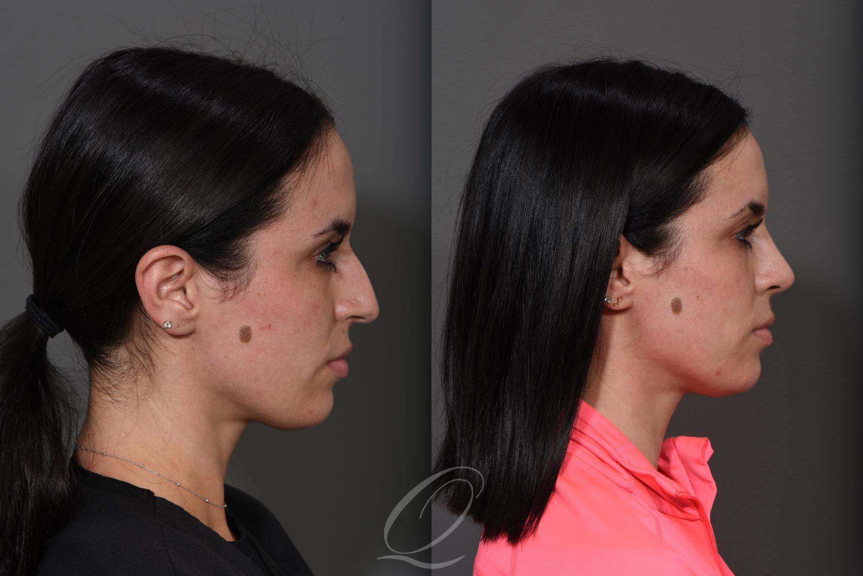 Rhinoplasty Case 362 Before & After View #3 | Serving Rochester, Syracuse & Buffalo, NY | Quatela Center for Plastic Surgery