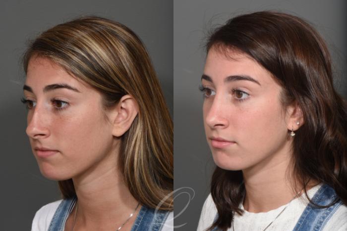Rhinoplasty Case 364 Before & After View #1 | Serving Rochester, Syracuse & Buffalo, NY | Quatela Center for Plastic Surgery