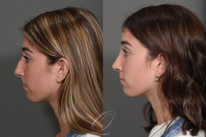 Rhinoplasty Case 364 Before & After View #2 | Serving Rochester, Syracuse & Buffalo, NY | Quatela Center for Plastic Surgery