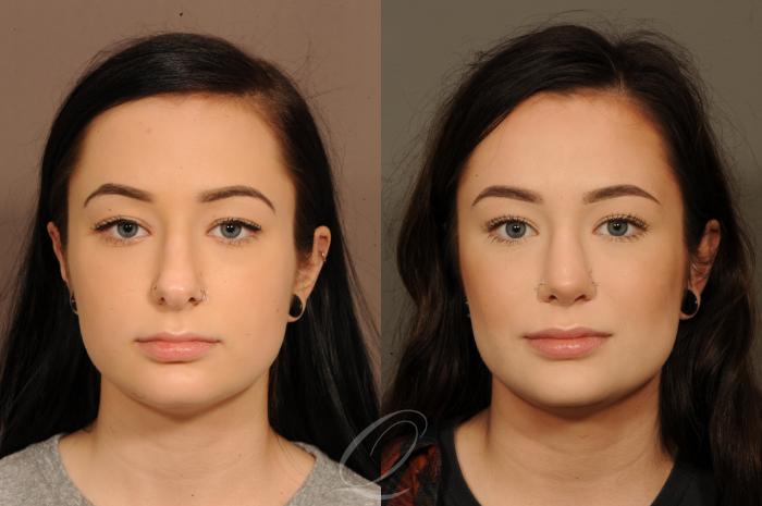 Rhinoplasty Case 365 Before & After View #1 | Serving Rochester, Syracuse & Buffalo, NY | Quatela Center for Plastic Surgery