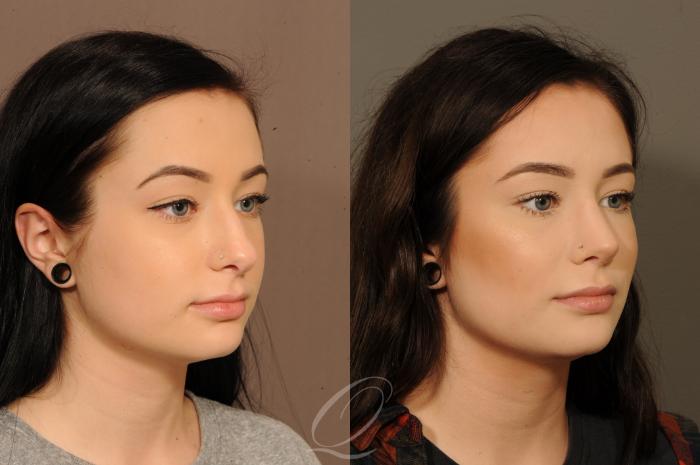 Rhinoplasty Case 365 Before & After View #2 | Serving Rochester, Syracuse & Buffalo, NY | Quatela Center for Plastic Surgery