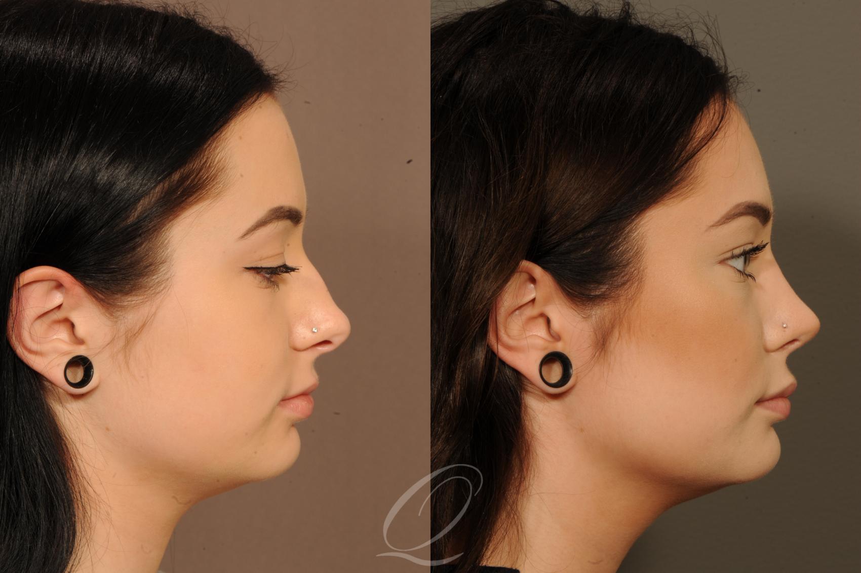 Rhinoplasty Case 365 Before & After View #3 | Serving Rochester, Syracuse & Buffalo, NY | Quatela Center for Plastic Surgery