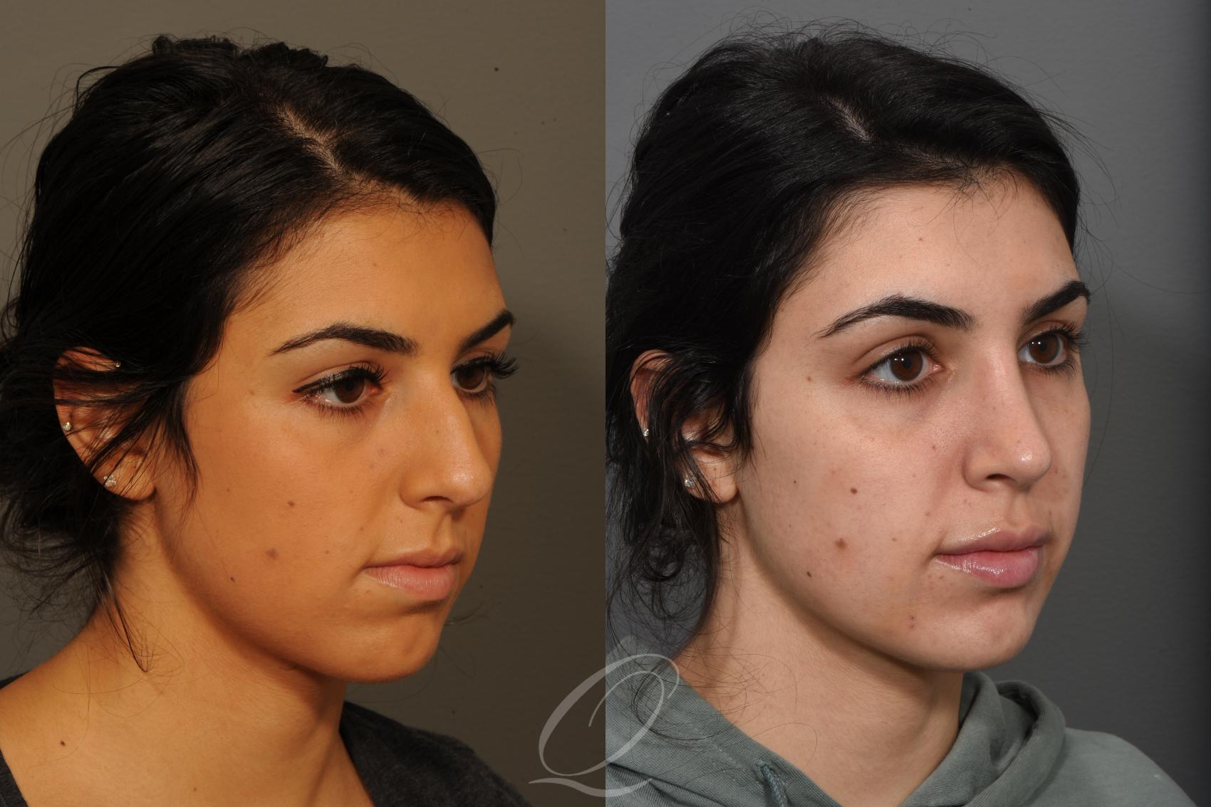 Rhinoplasty Case 371 Before & After View #1 | Serving Rochester, Syracuse & Buffalo, NY | Quatela Center for Plastic Surgery