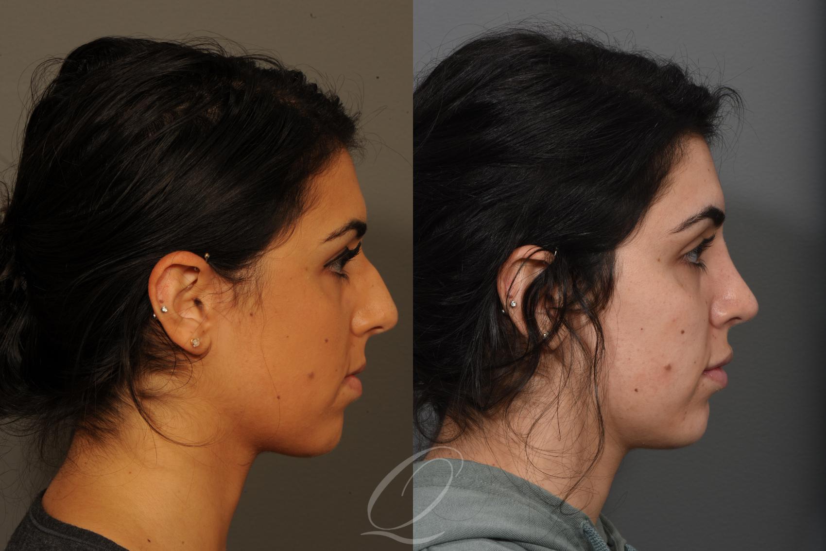 Rhinoplasty Case 371 Before & After View #2 | Serving Rochester, Syracuse & Buffalo, NY | Quatela Center for Plastic Surgery