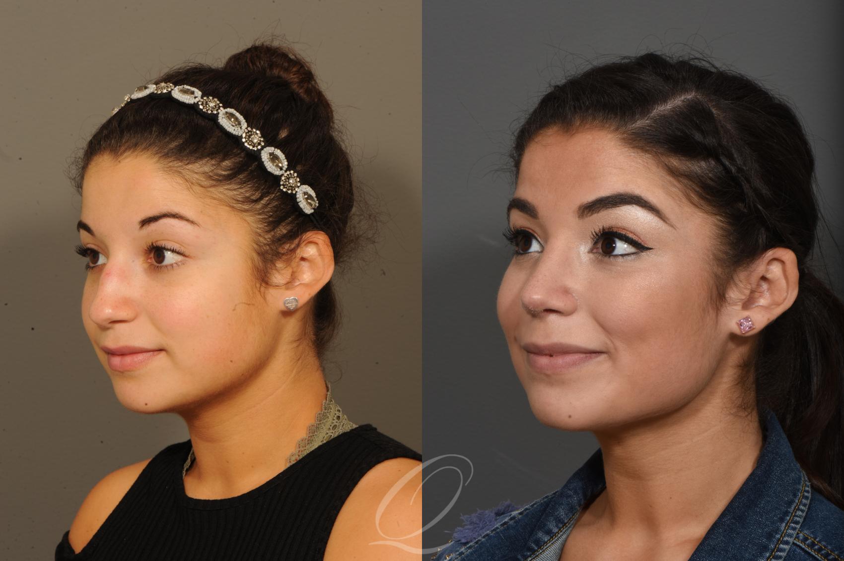 Rhinoplasty Case 388 Before & After View #2 | Serving Rochester, Syracuse & Buffalo, NY | Quatela Center for Plastic Surgery