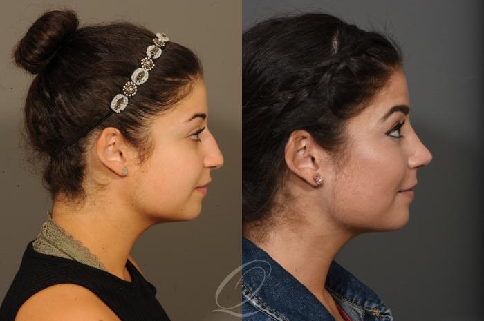 Rhinoplasty Case 388 Before & After View #3 | Serving Rochester, Syracuse & Buffalo, NY | Quatela Center for Plastic Surgery