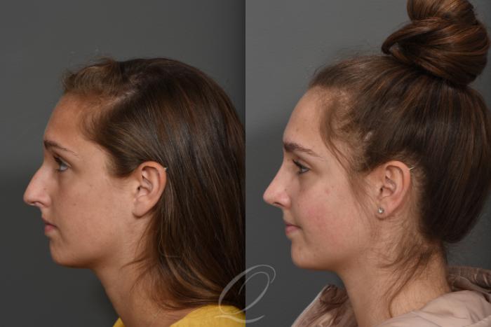 Rhinoplasty Case 396 Before & After Left Side | Serving Rochester, Syracuse & Buffalo, NY | Quatela Center for Plastic Surgery