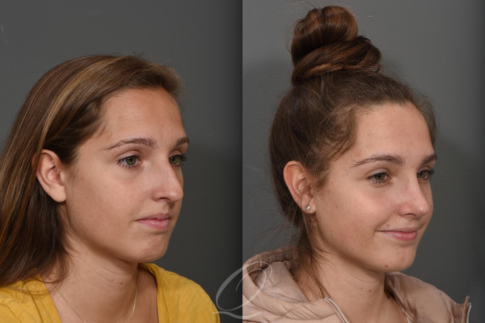Rhinoplasty Case 396 Before & After Right Oblique | Serving Rochester, Syracuse & Buffalo, NY | Quatela Center for Plastic Surgery