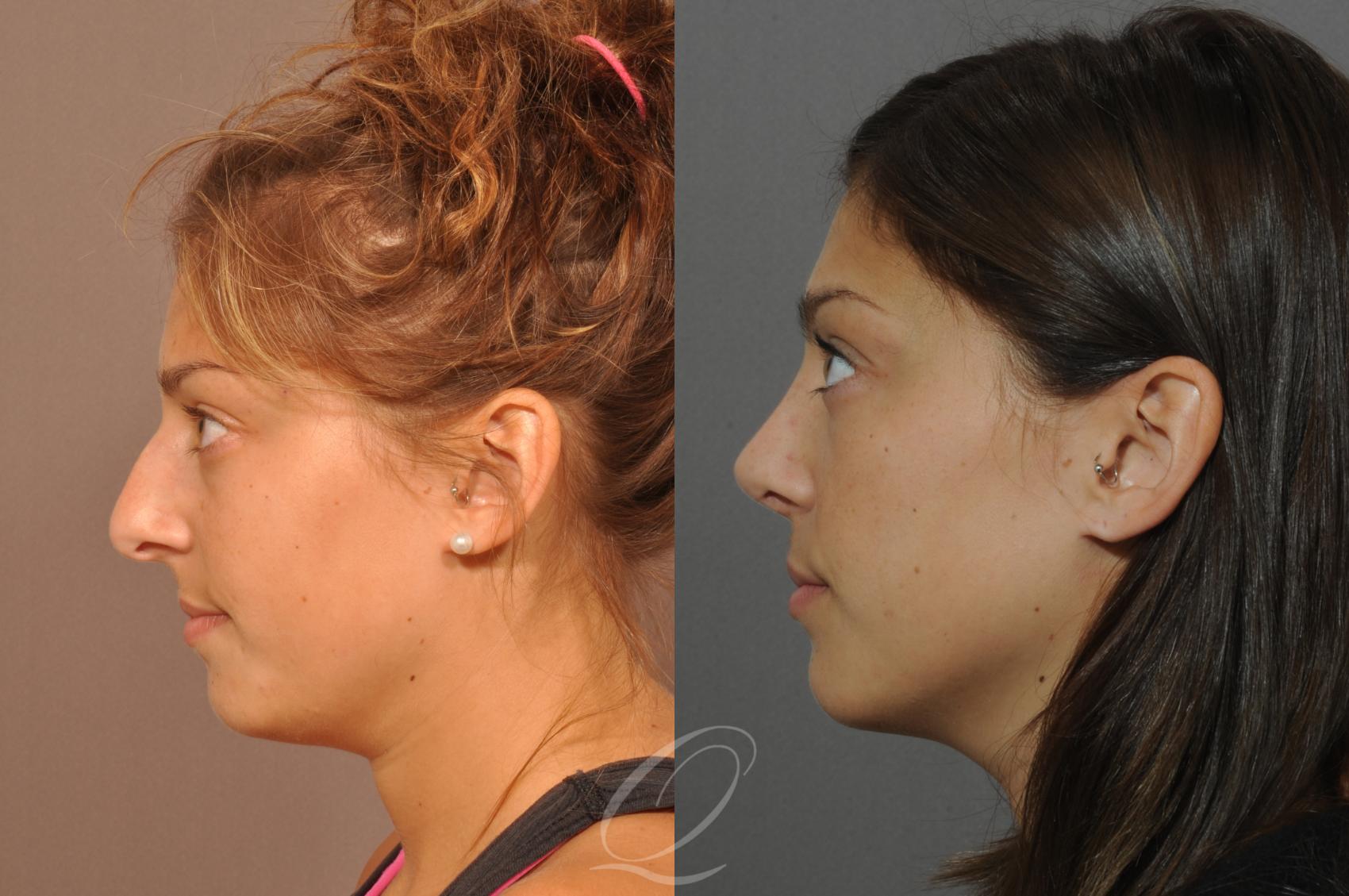 Rhinoplasty Case 42 Before & After View #2 | Serving Rochester, Syracuse & Buffalo, NY | Quatela Center for Plastic Surgery