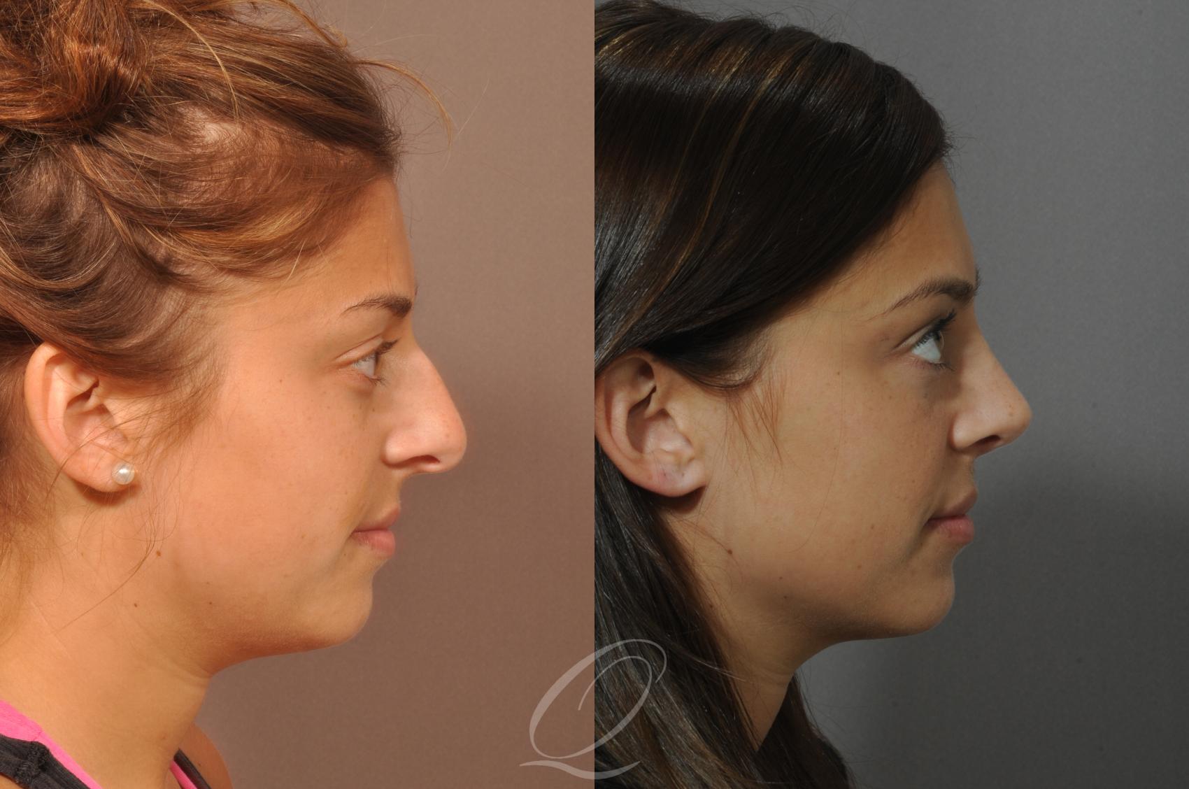 Rhinoplasty Case 42 Before & After View #3 | Serving Rochester, Syracuse & Buffalo, NY | Quatela Center for Plastic Surgery