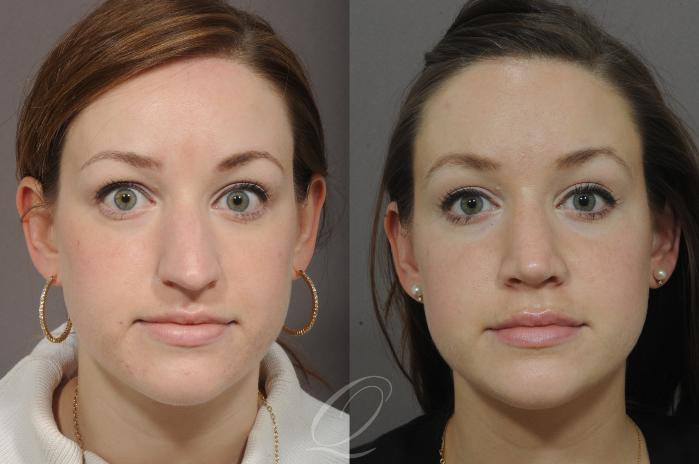 Rhinoplasty Case 43 Before & After View #1 | Serving Rochester, Syracuse & Buffalo, NY | Quatela Center for Plastic Surgery