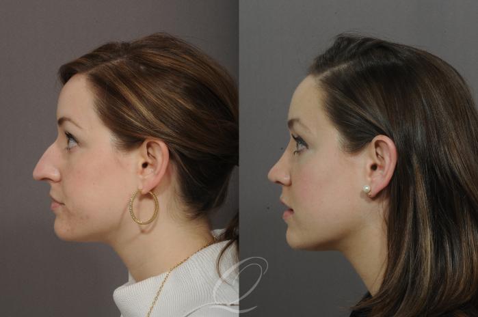 Rhinoplasty Case 43 Before & After View #2 | Serving Rochester, Syracuse & Buffalo, NY | Quatela Center for Plastic Surgery
