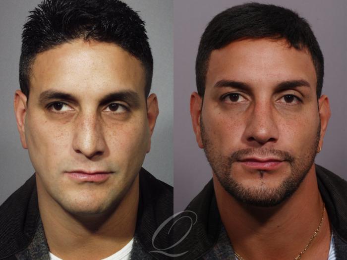 Rhinoplasty Case 50 Before & After View #1 | Serving Rochester, Syracuse & Buffalo, NY | Quatela Center for Plastic Surgery