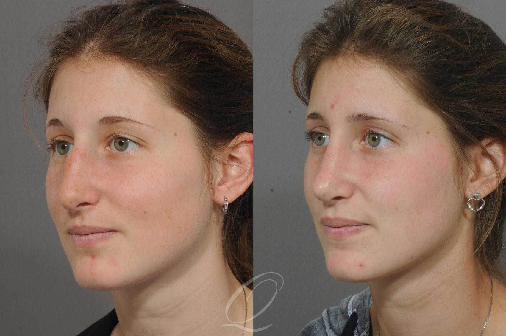 Rhinoplasty Case 51 Before & After View #2 | Serving Rochester, Syracuse & Buffalo, NY | Quatela Center for Plastic Surgery