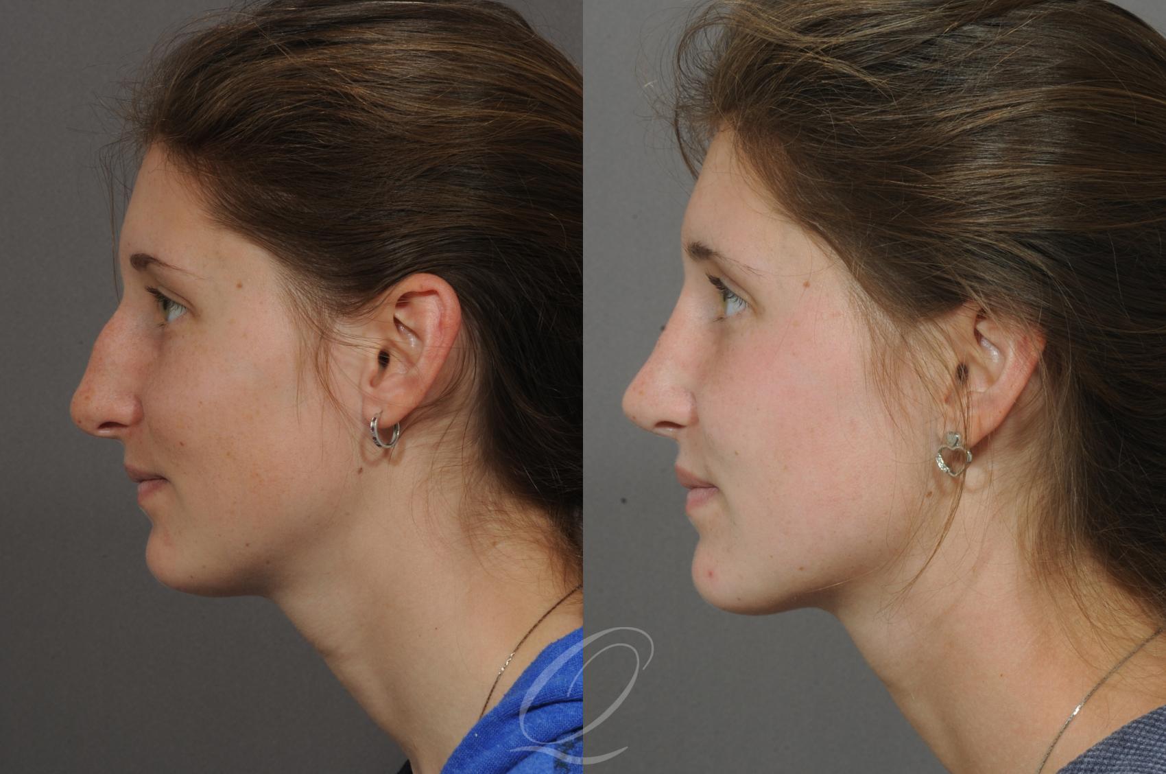 Rhinoplasty Case 51 Before & After View #3 | Serving Rochester, Syracuse & Buffalo, NY | Quatela Center for Plastic Surgery