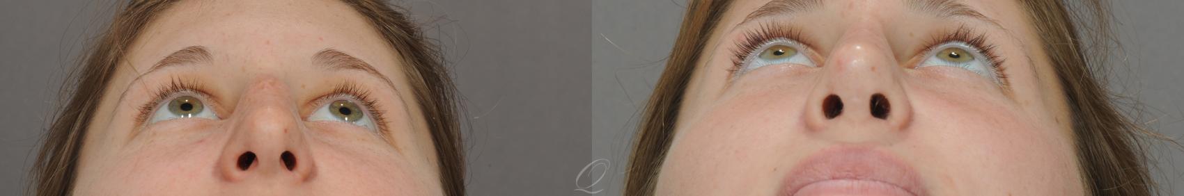 Rhinoplasty Case 51 Before & After View #5 | Serving Rochester, Syracuse & Buffalo, NY | Quatela Center for Plastic Surgery