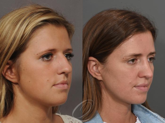 Rhinoplasty Case 52 Before & After View #2 | Serving Rochester, Syracuse & Buffalo, NY | Quatela Center for Plastic Surgery