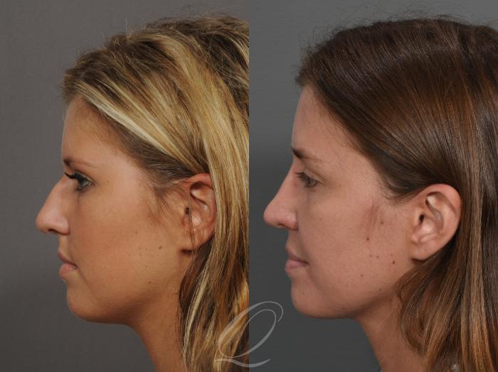 Rhinoplasty Case 52 Before & After View #3 | Serving Rochester, Syracuse & Buffalo, NY | Quatela Center for Plastic Surgery