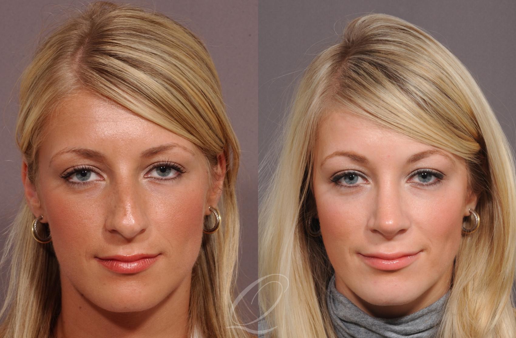 Rhinoplasty Case 53 Before & After View #1 | Serving Rochester, Syracuse & Buffalo, NY | Quatela Center for Plastic Surgery