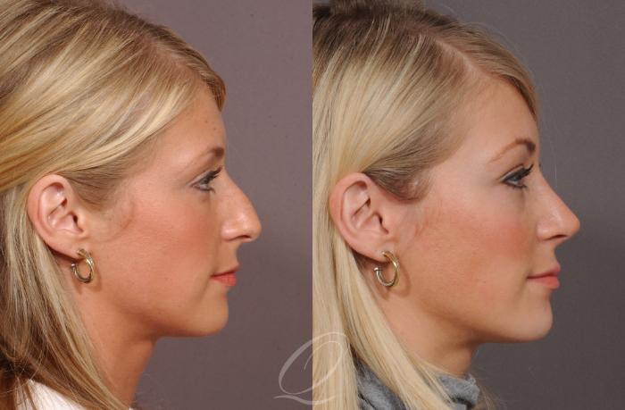 Rhinoplasty Case 53 Before & After View #2 | Serving Rochester, Syracuse & Buffalo, NY | Quatela Center for Plastic Surgery