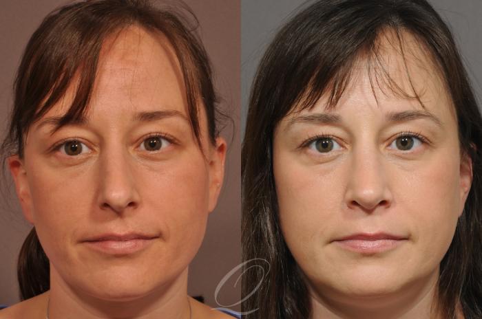 Rhinoplasty Case 54 Before & After View #1 | Serving Rochester, Syracuse & Buffalo, NY | Quatela Center for Plastic Surgery