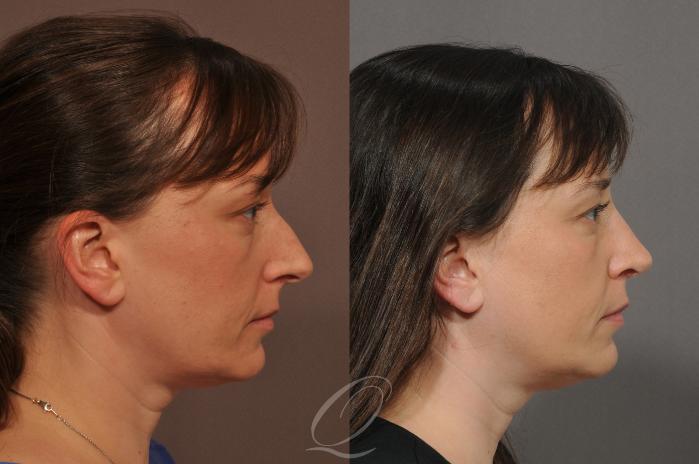 Rhinoplasty Case 54 Before & After View #2 | Serving Rochester, Syracuse & Buffalo, NY | Quatela Center for Plastic Surgery