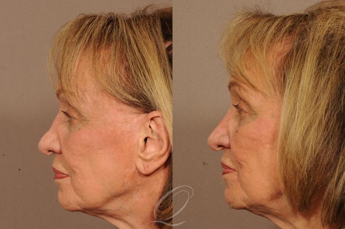 Rhinoplasty | Non-Surgical Case 275 Before & After View #2 | Serving Rochester, Syracuse & Buffalo, NY | Quatela Center for Plastic Surgery