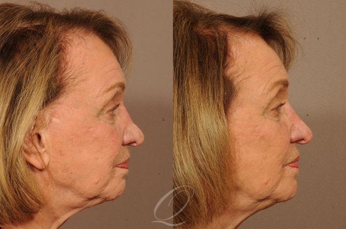 Rhinoplasty | Non-Surgical Case 275 Before & After View #3 | Serving Rochester, Syracuse & Buffalo, NY | Quatela Center for Plastic Surgery