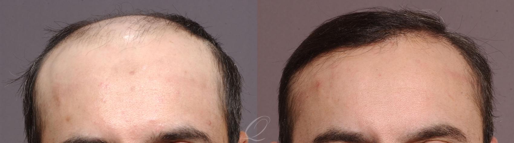 Scalp Reduction Case 1056 Before & After View #1 | Rochester, NY | Quatela Center for Hair Restoration