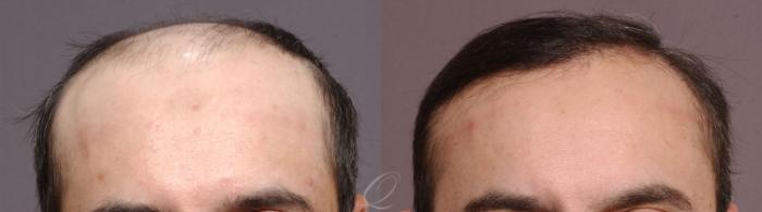 Scalp Reduction Case 1056 Before & After View #1 | Rochester, Buffalo, & Syracuse, NY | Quatela Center for Hair Restoration