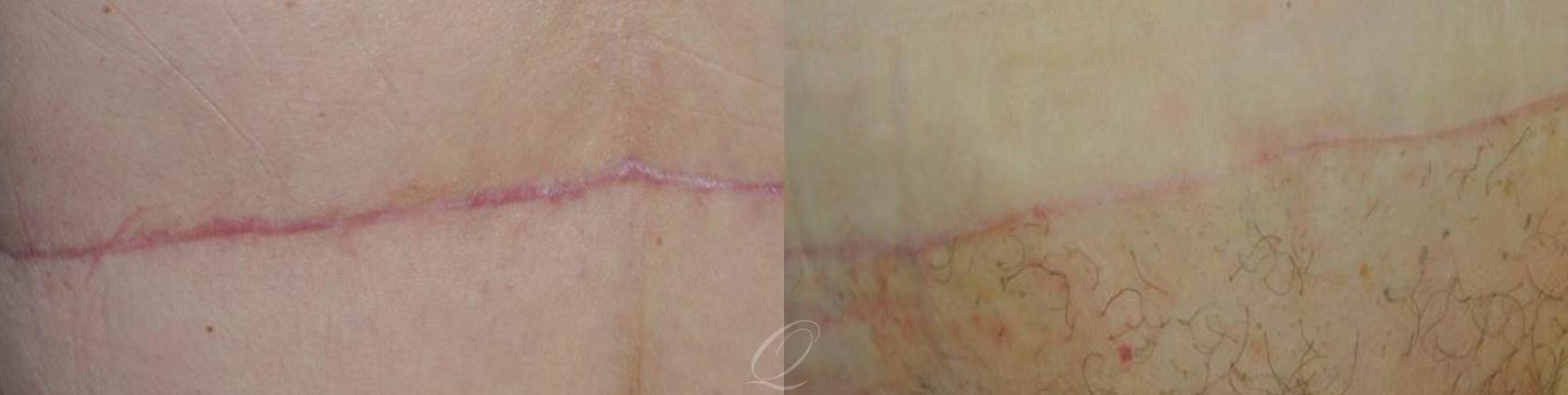 Scar Revision/Therapies Case 249 Before & After View #1 | Serving Rochester, Syracuse & Buffalo, NY | Quatela Center for Plastic Surgery