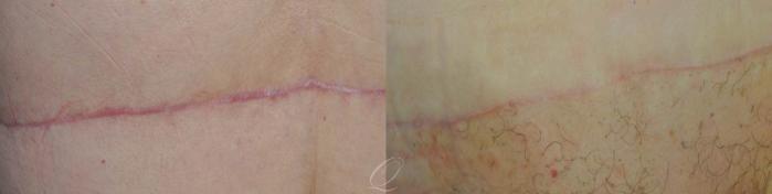 Scar Revision/Therapies Case 249 Before & After View #1 | Serving Rochester, Syracuse & Buffalo, NY | Quatela Center for Plastic Surgery