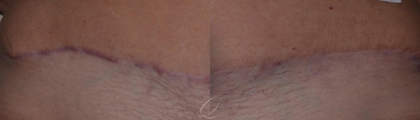Scar Revision/Therapies Case 252 Before & After View #1 | Serving Rochester, Syracuse & Buffalo, NY | Quatela Center for Plastic Surgery