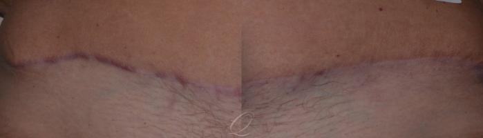 Scar Revision/Therapies Before & After Photos Patient 252, Serving  Rochester, Syracuse & Buffalo, NY